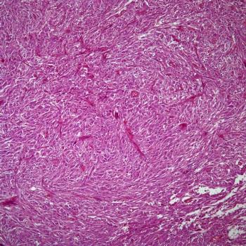Data from a phase 2 trial assessing lenalidomide in patients under 22 years of age also highlight an optimal dose level for this population.