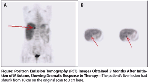 Metastatic Adrenocortical Carcinoma With a Prolonged Response to Mitotane 
