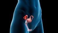 Disease Stage and Age Are Adverse Prognostic Risk Factors for Ovarian Germ Cell Tumors: © Sebastian Kaulitzki - stock.adobe.com