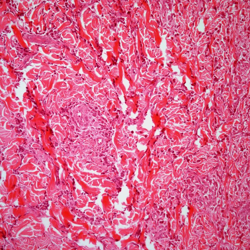 EP0042 shows promising early clinical efficacy in patients with pretreated acute myeloid leukemia, according to investigators.