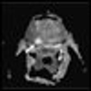 Evolution of the Concept of Focal Therapy for Prostate Cancer