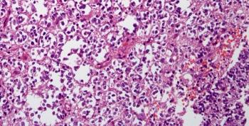 Data from the phase 2 FIREFLY-1 trial indicated that tovorafenib yielded responses among pretreated patients with recurrent or progressive pediatric low-grade glioma.