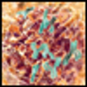 ASH: Obinutuzumab Bests Rituximab in Patients With Relapsed Non-Hodgkin Lymphoma