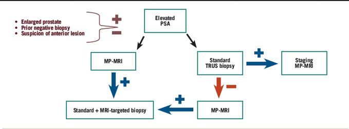 When To Order An Mri In The Initial Evaluation And Management Of Prostate Cancer