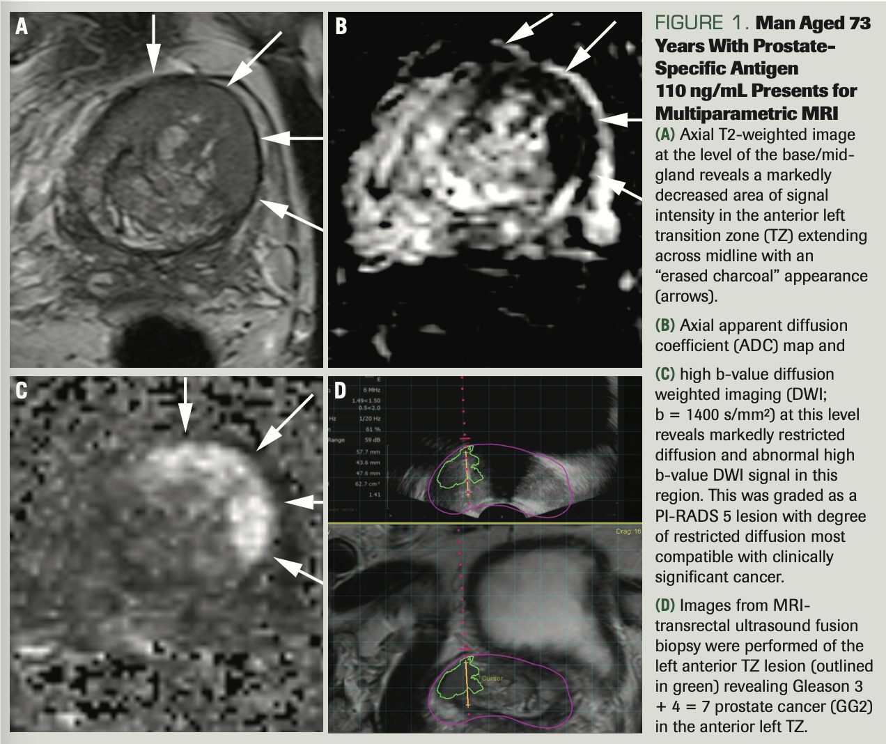FIGURE 1. Man Aged 73 Years With Prostate- Specific Antigen
110 ng/mL Presents for Multiparametric MRI



(A) Axial T2-weighted image at the level of the base/mid- gland reveals a markedly decreased area of signal intensity in the anterior left transition zone (TZ) extending across midline with an “erased charcoal” appearance (arrows).



(B) Axial apparent diffusion coefficient (ADC) map and



(C) high b-value diffusion weighted imaging (DWI;
b = 1400 s/mm2) at this level reveals markedly restricted diffusion and abnormal high b-value DWI signal in this region. This was graded as a PI-RADS 5 lesion with degree of restricted diffusion most compatible with clinically significant cancer.



(D) Images from MRI- transrectal ultrasound fusion biopsy were performed of the left anterior TZ lesion (outlined in green) revealing Gleason 3 + 4 = 7 prostate cancer (GG2) in the anterior left TZ.