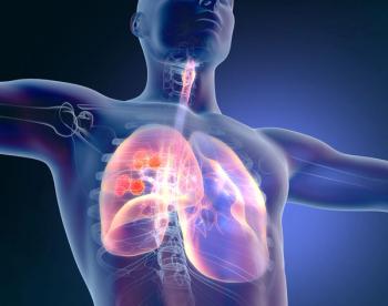 Results from a phase 2 study showed a median OS of 10.2 months in all patients with small cell lung cancer who received stereotactic radiation therapy.