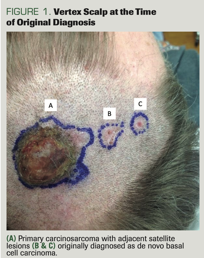 Metastatic Basal Cell Carcinoma Arising From A Primary Cutaneous