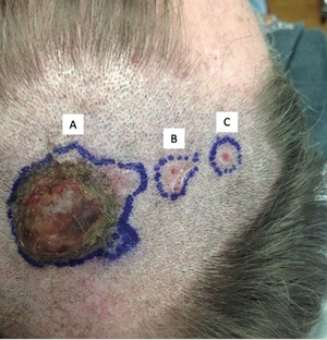 Metastatic Basal Cell Carcinoma Arising From a Primary Cutaneous Carcinosarcoma