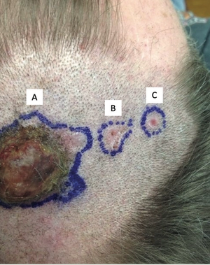 Metastatic Basal Cell Carcinoma Arising From a Primary Cutaneous Carcinosarcoma