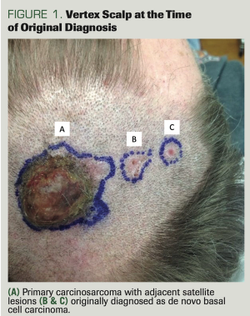 Metastatic Basal Cell Carcinoma Arising From a Primary Cutaneous Carcinosarcoma