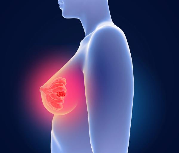 3d illustration of breast cancer - Mammakarzinom: © Lars Neumann - stock.adobe.com