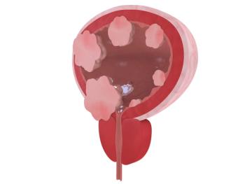 Apalutamide plus stereotactic radiotherapy may be effective for certain patients with recurrent prostate cancer following radical prostatectomy.