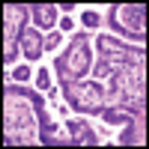 Unexpected N2 Lymph Node Involvement Found During Surgery for Early-Stage NSCLC