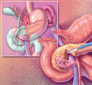New Treatment Options and Management Considerations in Borderline Resectable Pancreatic Cancer