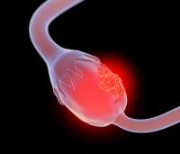 Avutometinib/Defactinib Shows Activity in KRAS Wild-Type Recurrent LGSOC: © Lars Neumann - stock.adobe.com