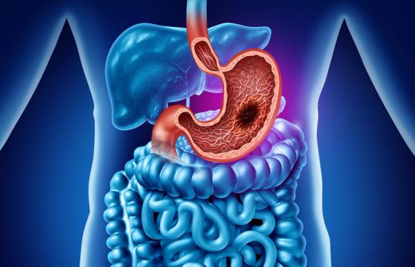 Zanidatamab Regimens Extends OS in First-Line HER2+ Advanced Gastric Cancers: © freshidea - stock.adobe.com