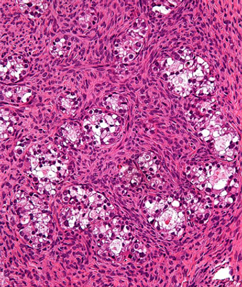Mirvetuximab soravtansine-gynx may have the potential to become a new standard for patients with folate receptor α–positive, platinum-resistant ovarian cancer, experts say.