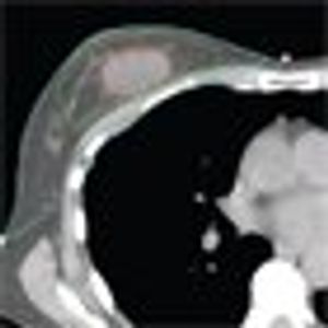 Accelerated Partial-Breast Irradiation: The Current State of Our Knowledge