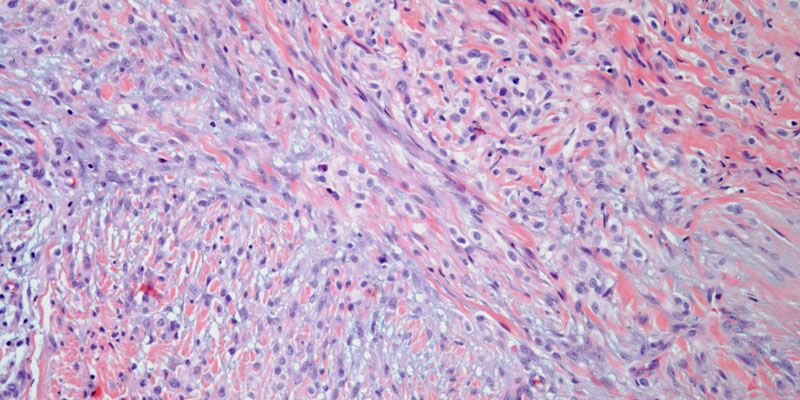 Pleural Thickening in 47-Year-Old Patient