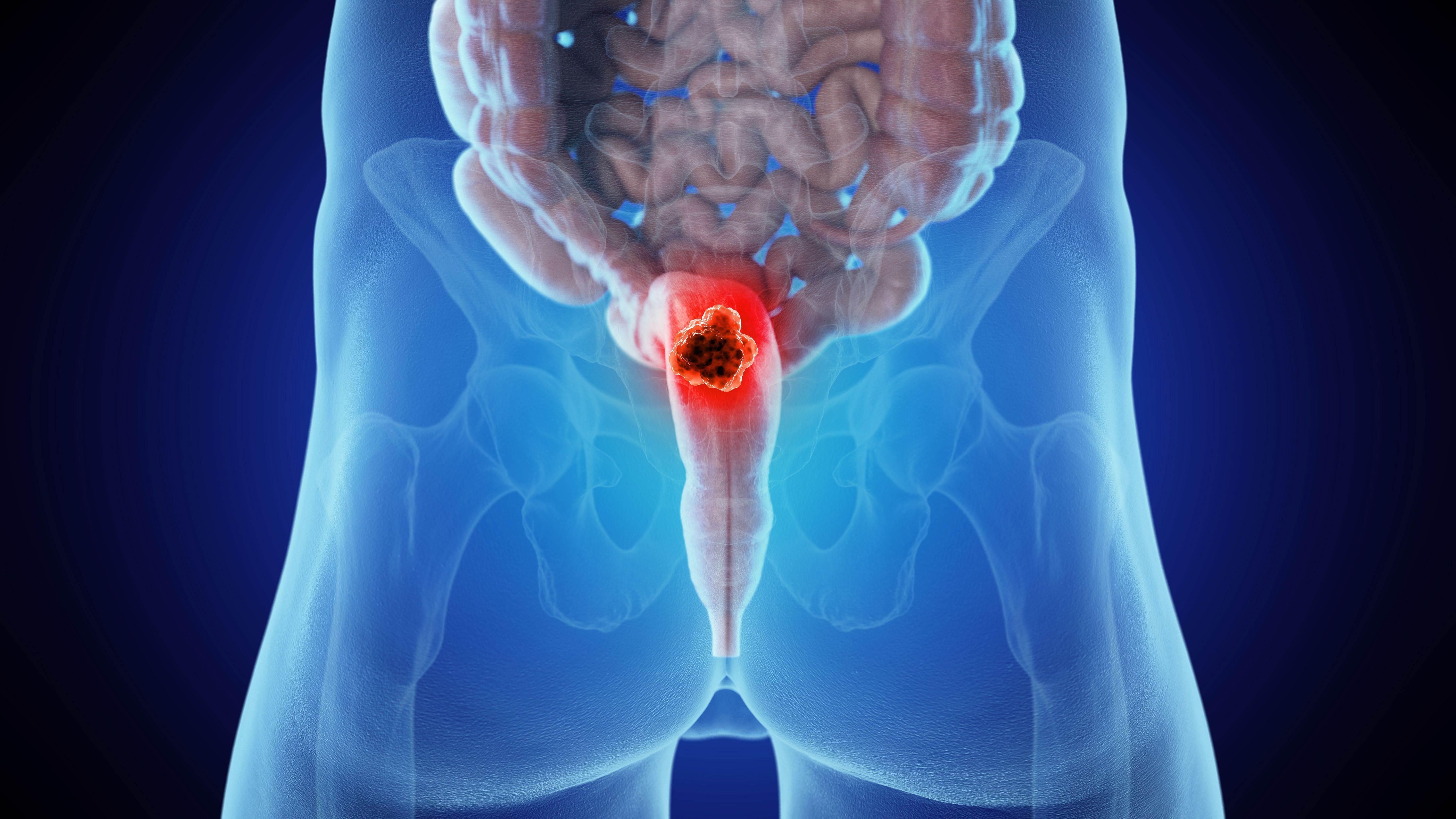 Baseline Tumor Cell Density May Predict Treatment Effect in Rectal Cancer: © Sebastian Kaulitzki - stock.adobe.com