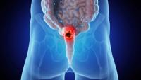 Baseline Tumor Cell Density May Predict Treatment Effect in Rectal Cancer: © Sebastian Kaulitzki - stock.adobe.com
