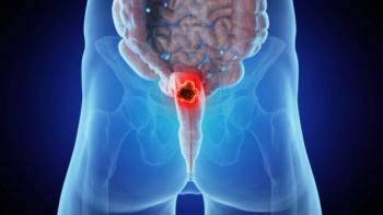 Baseline Tumor Cell Density May Predict Treatment Effect in Rectal Cancer: © Sebastian Kaulitzki - stock.adobe.com