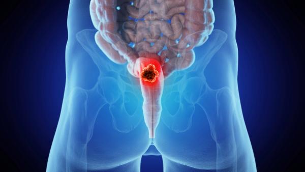 Baseline Tumor Cell Density May Predict Treatment Effect in Rectal Cancer: © Sebastian Kaulitzki - stock.adobe.com