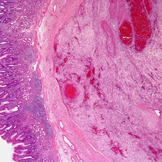 Pembrolizumab appears to improve overall survival vs placebo when added to trastuzumab and chemotherapy among patients with metastatic HER2-positive gastric or gastroesophageal junction cancer. 