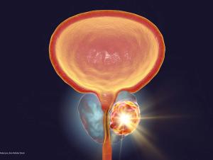 Prostate Cancer Focal Therapy Has Made Great Strides and the Future Remains Bright