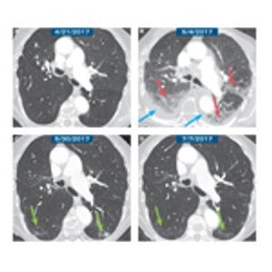 Pneumonitis From Anti–PD-1/ PD-L1 Therapy