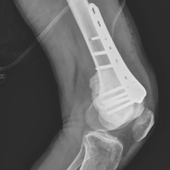 An Arthroscopic Approach for the Intralesional Curettage of Giant Cell Tumor of the Distal Femur: A Case Report