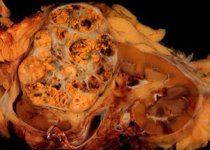 Slide Show: Renal Cell Carcinoma