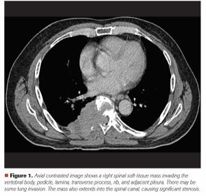 A 65-Year-Old Man With Back Pain and Imaging Findings of Spinal Cord Compression