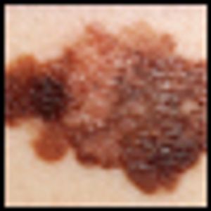 MEK1 Mutation Does Not Cause BRAF Inhibitor Resistance in BRAF-Mutated Melanoma