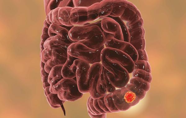 Pathological analysis showed that neoadjuvant radiotherapy was associated with the downstaging of locally advanced rectal cancer.
