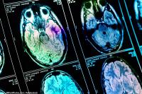 The submission of an investigational new drug application for a uPAR-targeted imaging agent, FG001, supports a planned phase 2 trial in glioma.