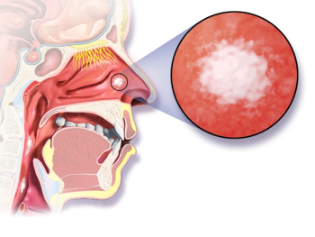 Patients with recurrent/metastatic head and neck squamous cell carcinoma and a PD-L1 combined positive score of 1 or more and 20 or more experienced a clinical benefit with first-line nivolumab plus ipilimumab compared with the EXTREME regimen.