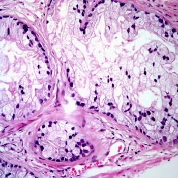 Incorporating PSMA PET into pre-surgical risk assessment may help urologists determine whether surgery should be performed on patients with advanced prostate cancer, according to Loïc Djaïleb, MD, PhD.