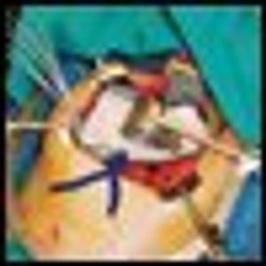 Radiation Therapy in the Treatment of Cholangiocarcinoma