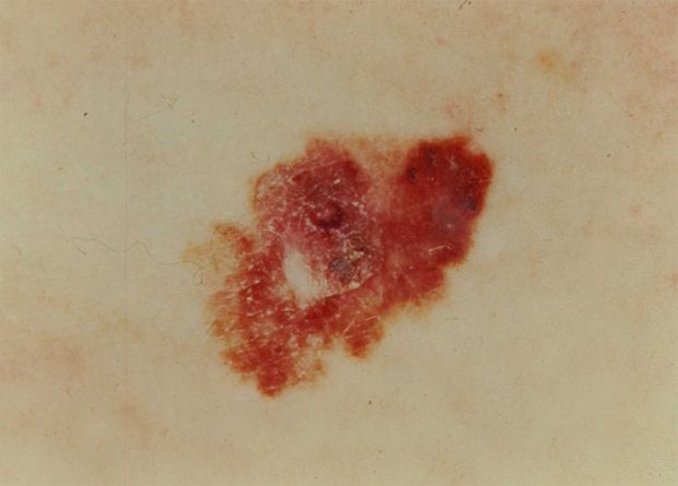 Red and brown melanoma lesion