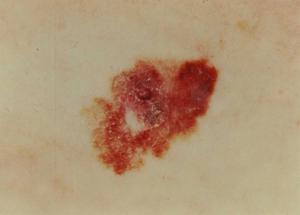 Slide Show: Melanoma and Other Skin Cancers