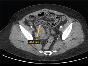 Synchronous Well-Differentiated Papillary Mesothelioma and Endometrioid Adenocarcinoma Arising From Endometriosis