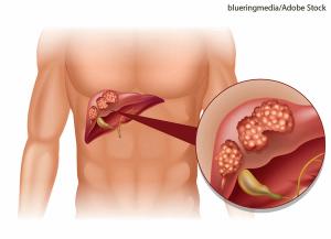 liver cancer prognosis