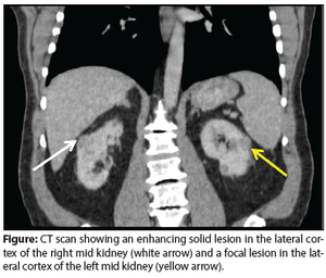 Renal Cancer Management in a Patient With Chronic Kidney Disease   