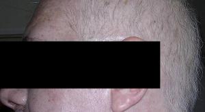 Extensive Hair Loss Following Second Round of Chemotherapy