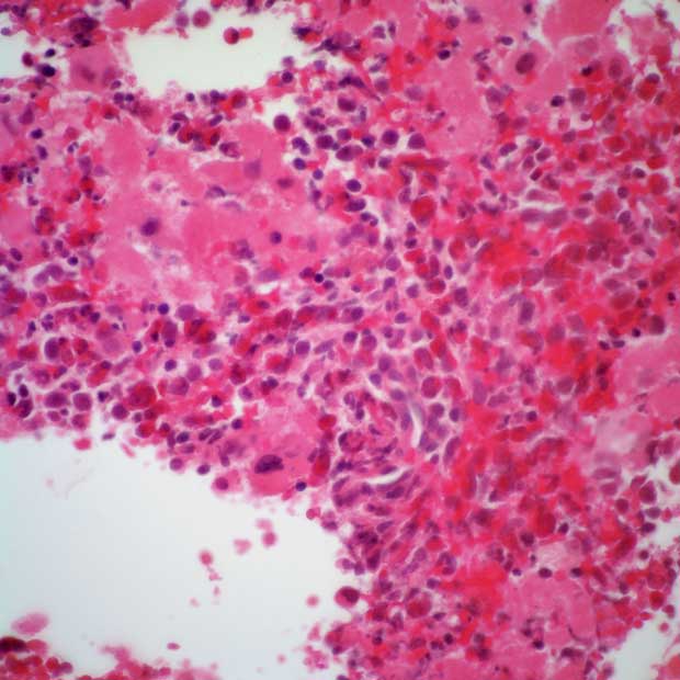 Treatment with asciminib produces a favorable safety profile among patients with Philadelphia chromosome–positive chronic myeloid leukemia in chronic phase.