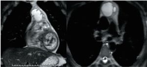 A Patient With Pure Teratoma of the Testis Presenting With an Anterior Mediastinal Mass