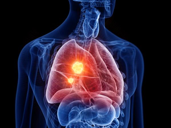 Nursing Strategies for the 3 First-Line Regimens in EGFR-Mutated NSCLC: © Sebastian Kaulitzki - stock.adobe.com