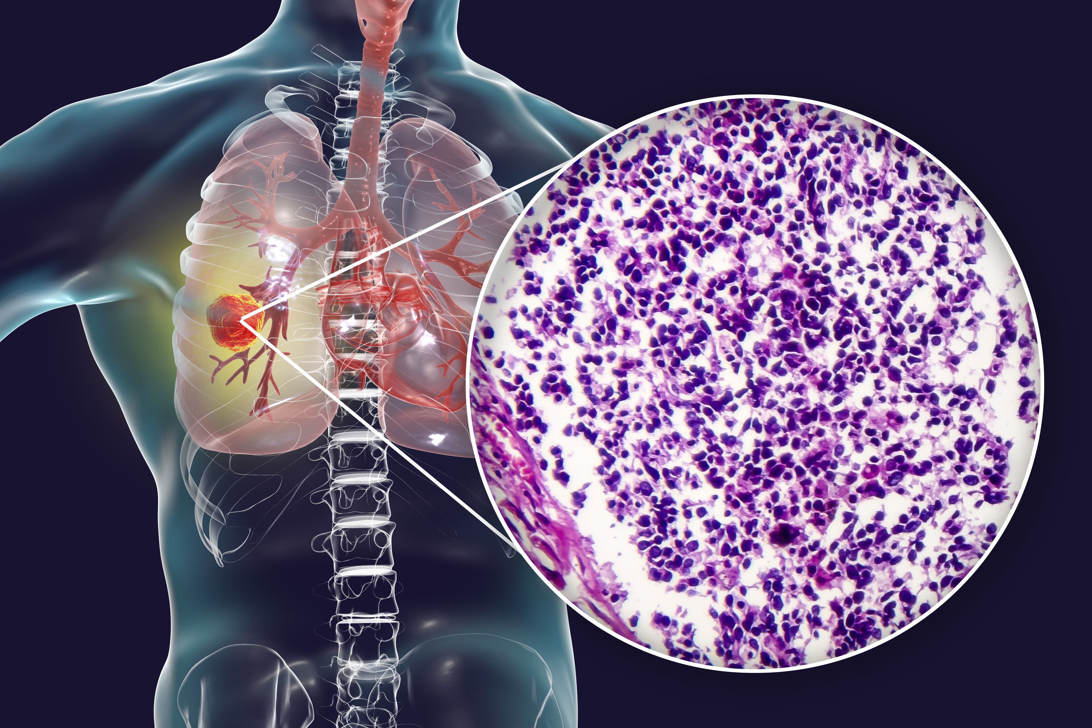 La mirtazapina puede aumentar el gasto energético y mejorar la calidad de vida en el NSCLC y la anorexia.