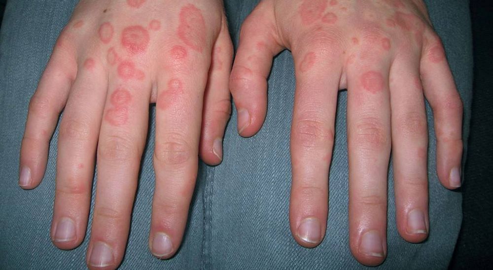 NSCLC Patient Develops Fever and Rash Following Treatment for Brain ...